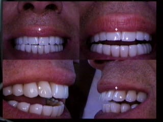dental veneers