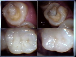 inlays-onlays-3