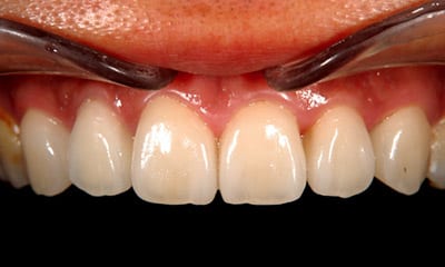 After porcelain veneers (Emax)