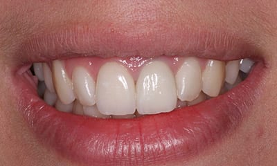 After correction with porcelain veneer Emax