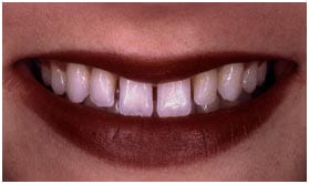 Before dental porcelain veneers
