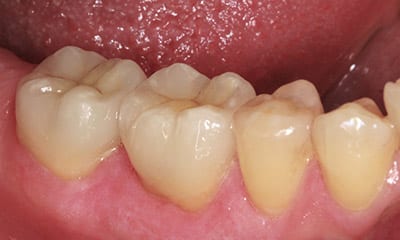 after back teeth with emax porcelain crowns