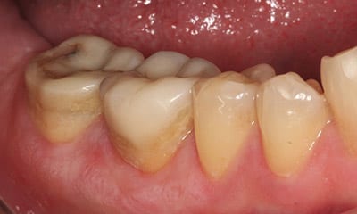 before back tooth needing porcelain crown
