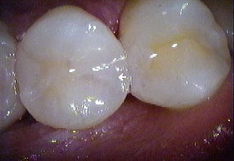 crown-after