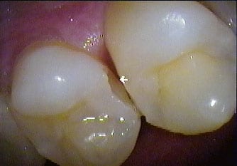 crown-before