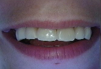 Dental Bonding Before and After