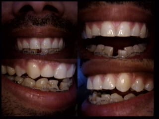 Before dental bridge