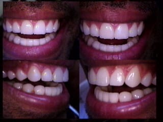 After dental bridge