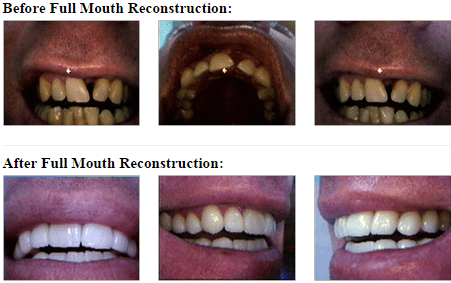 dental reconstruction in beverly hills full mouth reconstruction