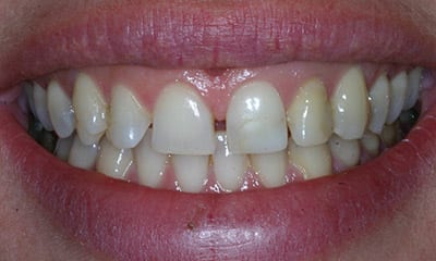 Before dental veneers vs dental bonding