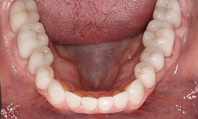 dental reconstruction in beverly hills Under-bite correction