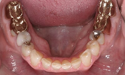 dental reconstruction in los angeles Under-bite correction