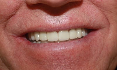 dental reconstruction in beverly hills After Dental Reconstruction