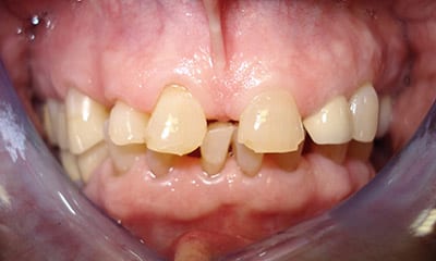 dental reconstruction in beverly hills Before Dental Reconstruction