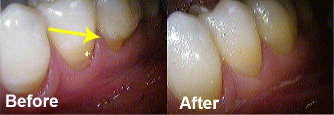 Dental bonding restoration due to gum recession