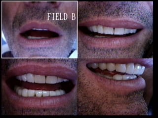 Full Mouth Reconstruction