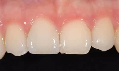 Front single tooth porcelain crown