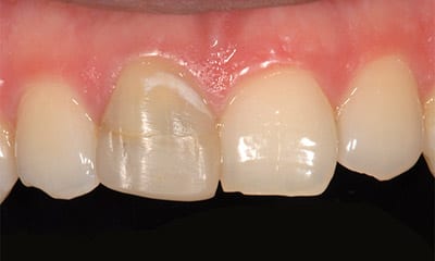 porcelain-crown-front-tooth