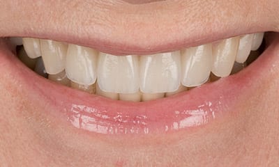 After smile make over correction of shape and gummy smile with emax porcelain
