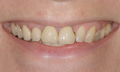 Before: Crooked discolored teeth with gummy smile