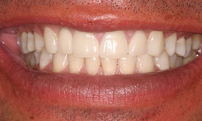 After dental veneers vs Dental bonding