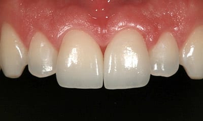 after porcelain emax crown