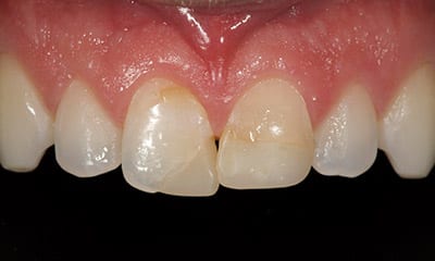 before porcelain crown