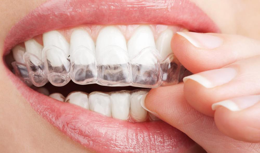 Gum damage or ulceration as the result teeth whitening gel ! Is this