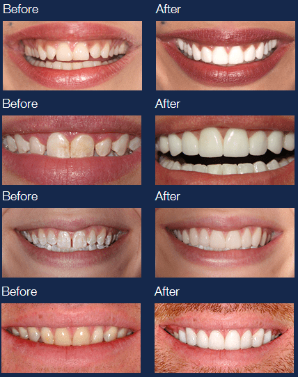 lumineer-before-after