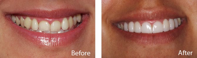 eMax Veneers