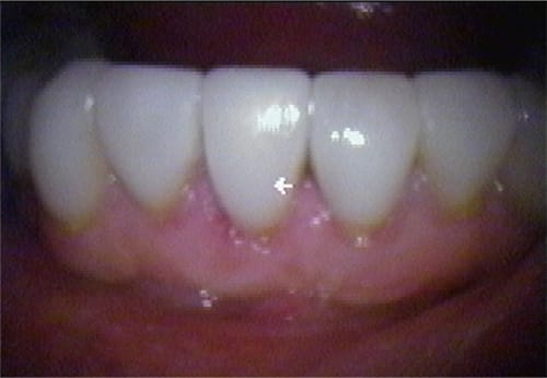 After dental veneers vs Dental bonding