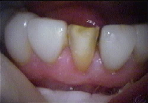 Before dental veneers vs dental bonding