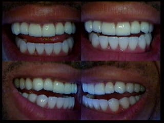 dental reconstruction in beverly hills Under-bite correction