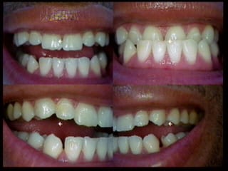 dental reconstruction in los angeles Under-bite correction