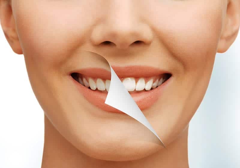 How Painful Is Teeth Whitening services in Los Angeles