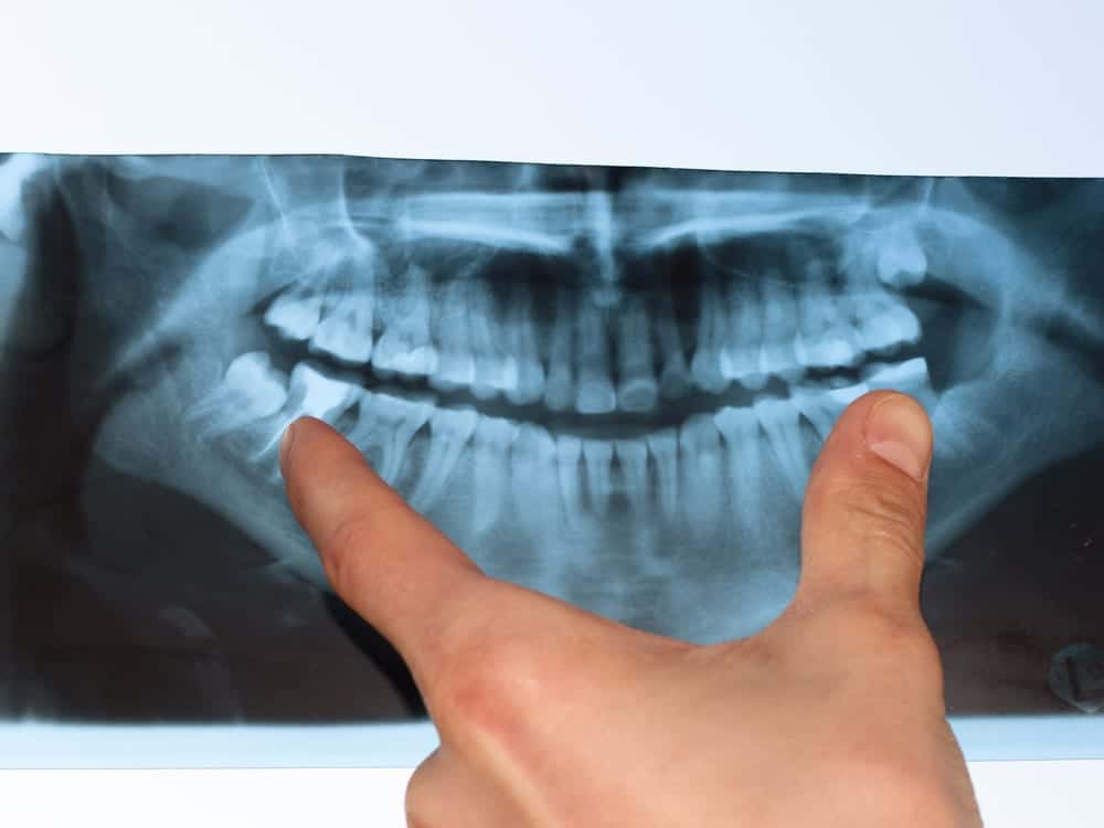 Things About Root Canals That You Must Know